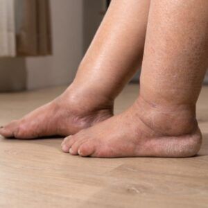 Liquido nelle gambe
