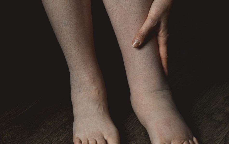 Liquido nelle gambe | Benessere News